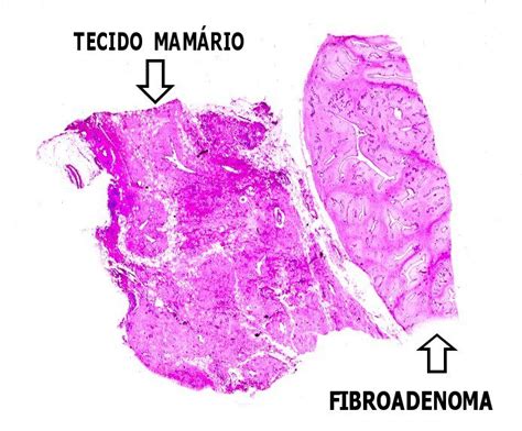 fibroadenom mamario anatomia patologica del